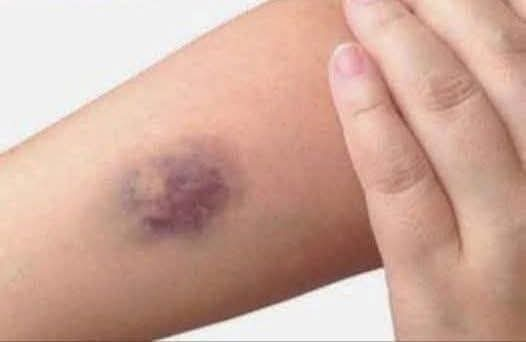 Understanding Bruises: Causes, Types, and Effective Treatments